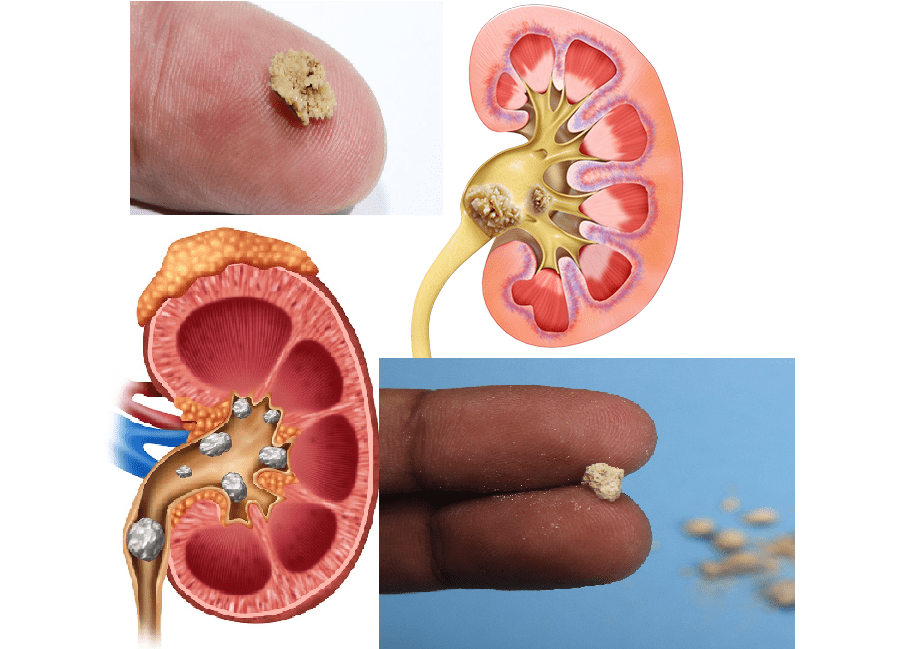 Kidney stones are painful than childbirth
