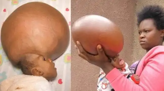 swollen head baby