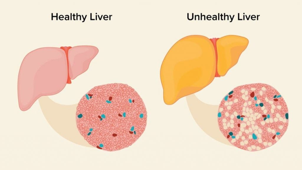 Fatty liver disease, four stages and recommended treatment