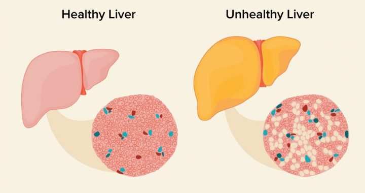 Fatty liver disease, four stages and recommended treatment