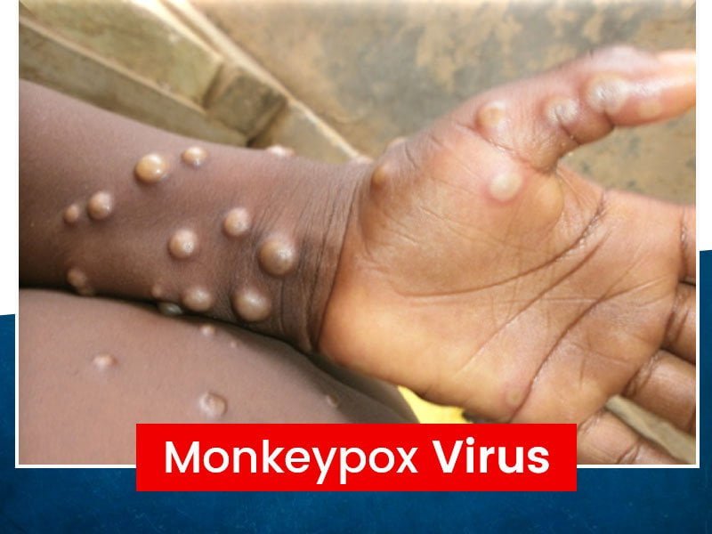 The World Health Organization (WHO) has declared Monkeypox a global health emergency as cases surge globally