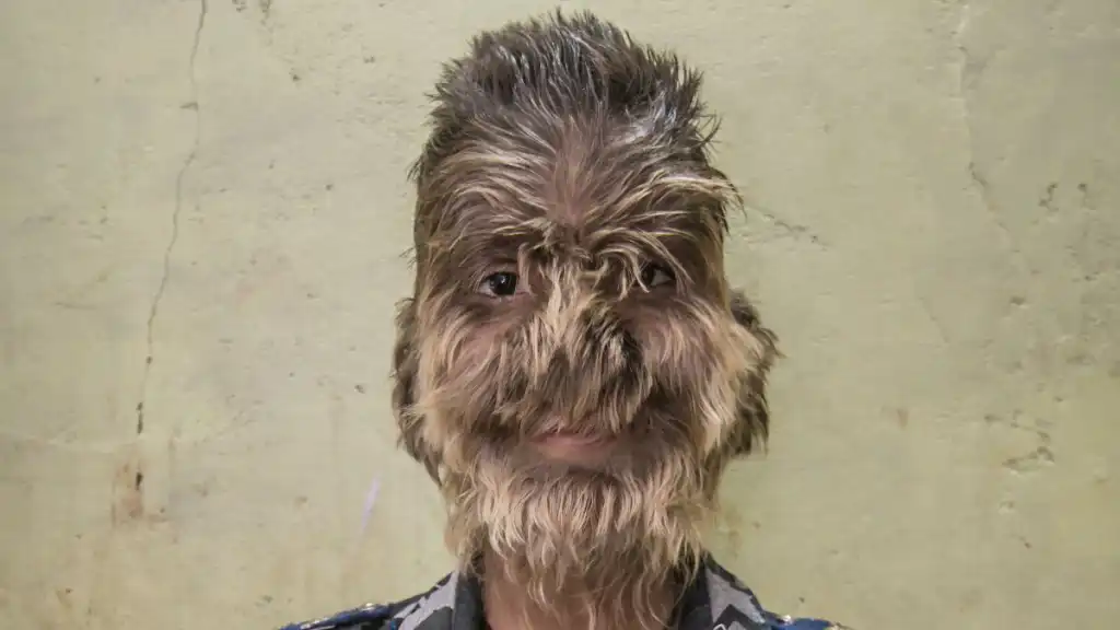 Boy With 'Werewolf Syndrome' Says Kids Are Scared Of Him And Worried He Will Bite Them