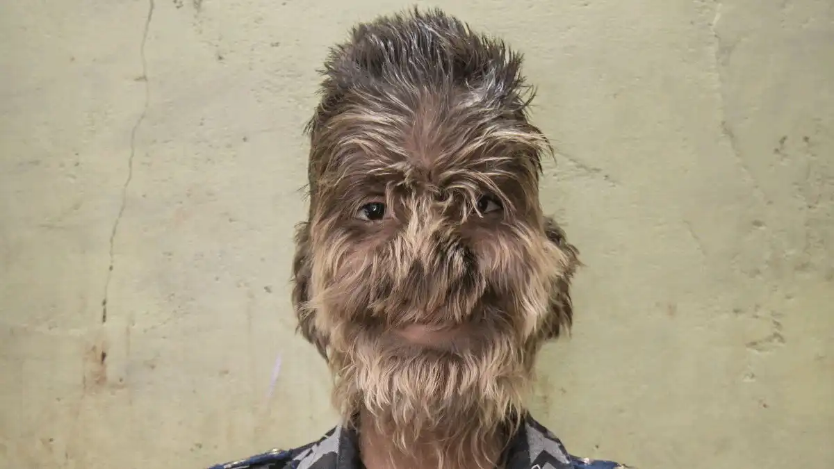 Boy With 'Werewolf Syndrome' Says Kids Are Scared Of Him And Worried He Will Bite Them