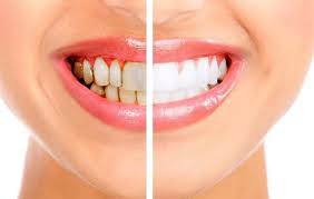 Natural Methods That Can Whiten Your Teeth