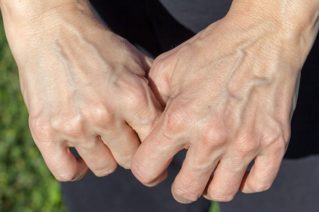 7 Emerging Reasons You Keep Seeing Your Veins and 5 Remedies To Consider