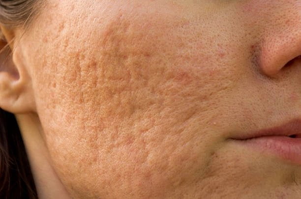 7 Ways To Completely Remove Pimples Scars On The Face