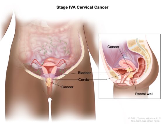 Cervical cancer: why it must be a mass media campaign. We need awareness campaign to reach more women with the information