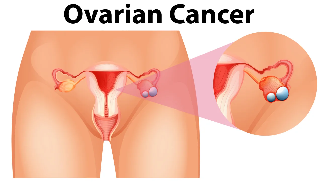 Check Out 2 Early Warning Signs Of Ovarian Cancer That Most Women Often Ignore
