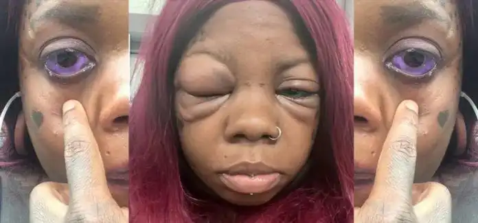 Anaya Peterson goes blind