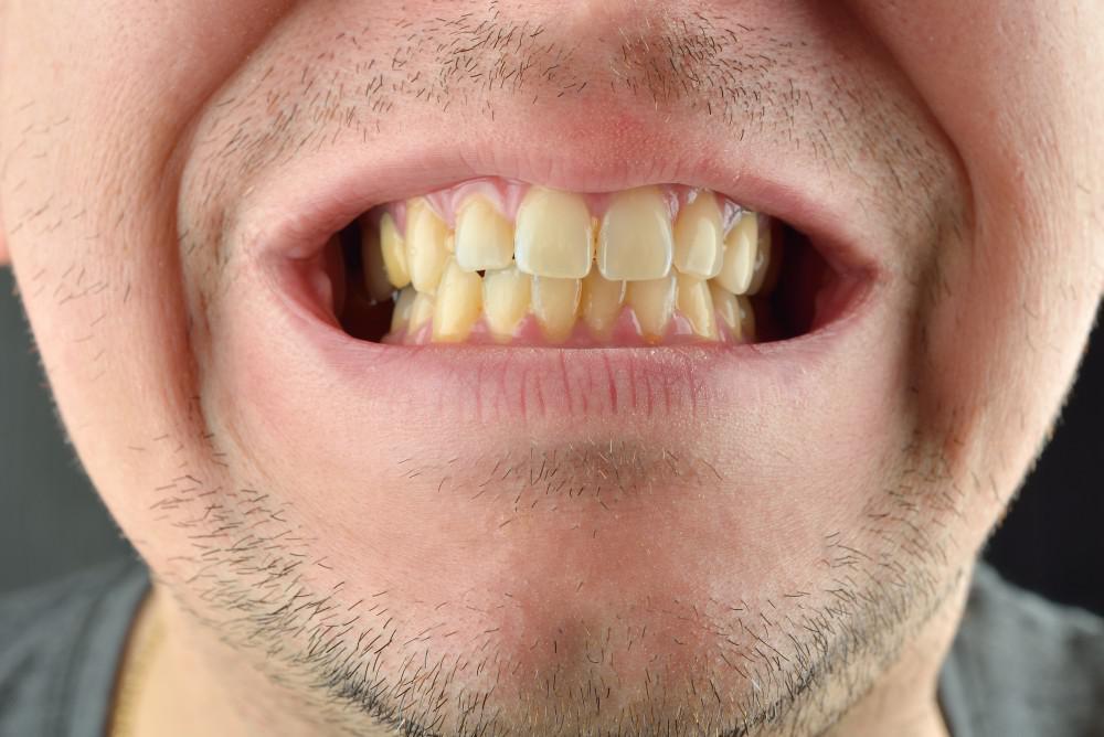 Natural Ways To Get Rid Of Your Yellow Teeth
