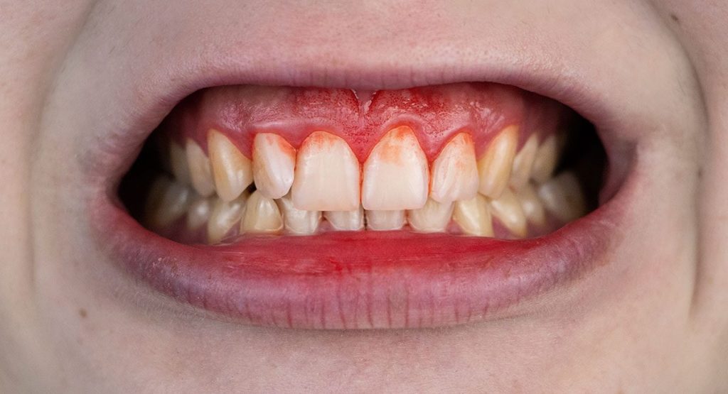 What It Means When Your Gums Bleed When Brushing Your Teeth
