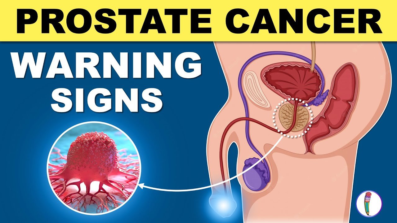 Understanding Prostate Cancer Symptoms: What Men Should Look Out For