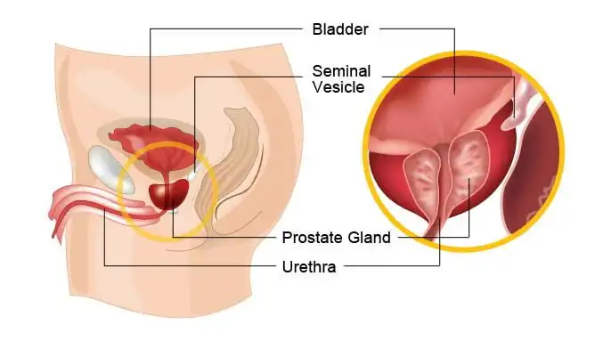 Preventing Prostate Cancer: Learn how to reduce your risk of prostate cancer through diet, exercise, screening, and lifestyle changes.  Risk Factors of Prostate Cancer