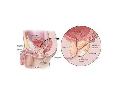 Prostate Cancer Diagnosis and Stages How Prostate cancer develops