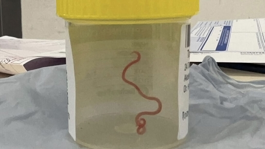 How Doctors found a live python parasite in a woman’s brain after the woman’s mysterious symptoms started in her stomach.