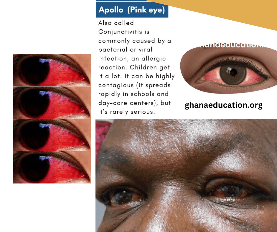 Apolo Eye Infection On The Rise Causes, Effects and Remedies