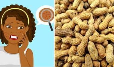 Does groundnuts cause pimples?