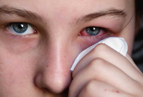 All You Need To Know About Hemorrhagic Conjunctivitis(Apollo)