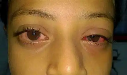 Understanding Apollo Eye Infection: Causes, Effects, Prevention, and Treatment