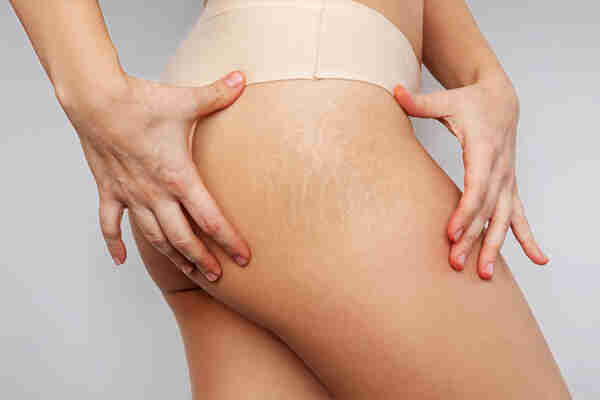 How To Remove Stretch Marks From Your Body Naturally