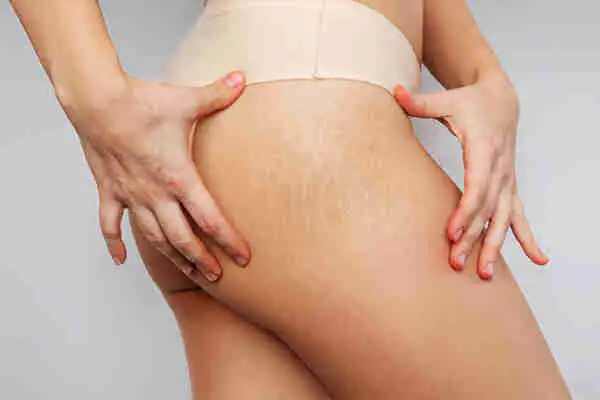 How To Remove Stretch Marks From Your Body Naturally