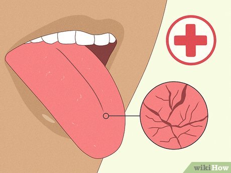 7 Things To Do If Your Tongue Gets Burned