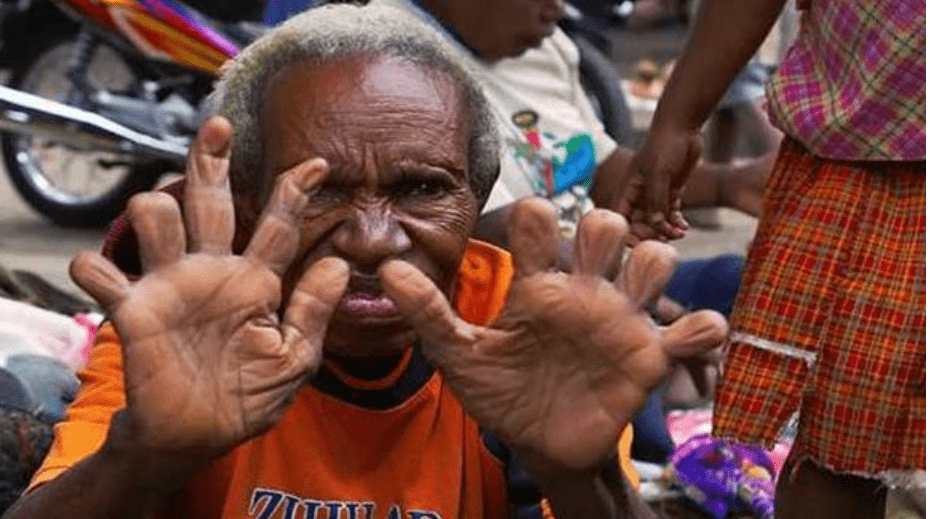 Meet the Dani Tribe, Where women cut off their fingers when a loved one dies