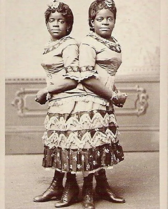 Strange stories of two Siamese twins born in1851 and 1912