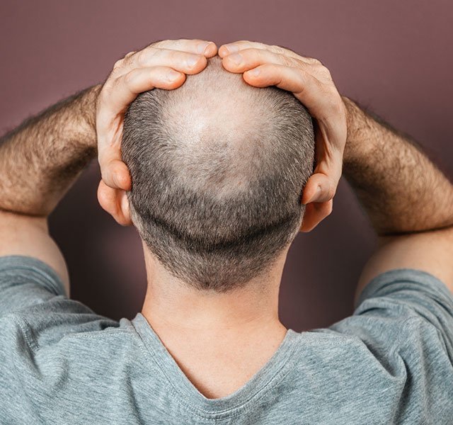 Causes Of Baldness In Men