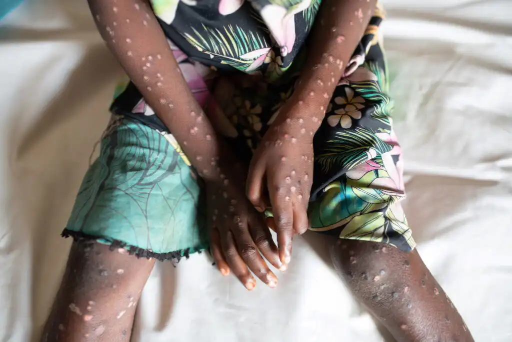 Ghana Confirms New Mpox Cases