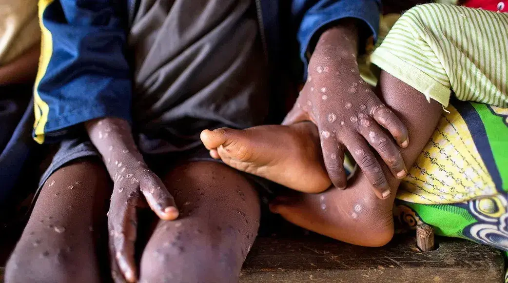 Breaking News: Ghana Records First Death In Mpox Case With 23 Active Cases