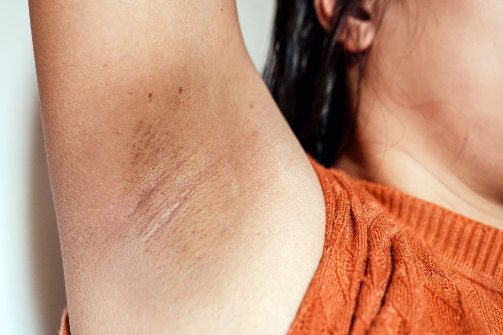 Must Read: Causes of Armpit Bumps and How To Treat Them